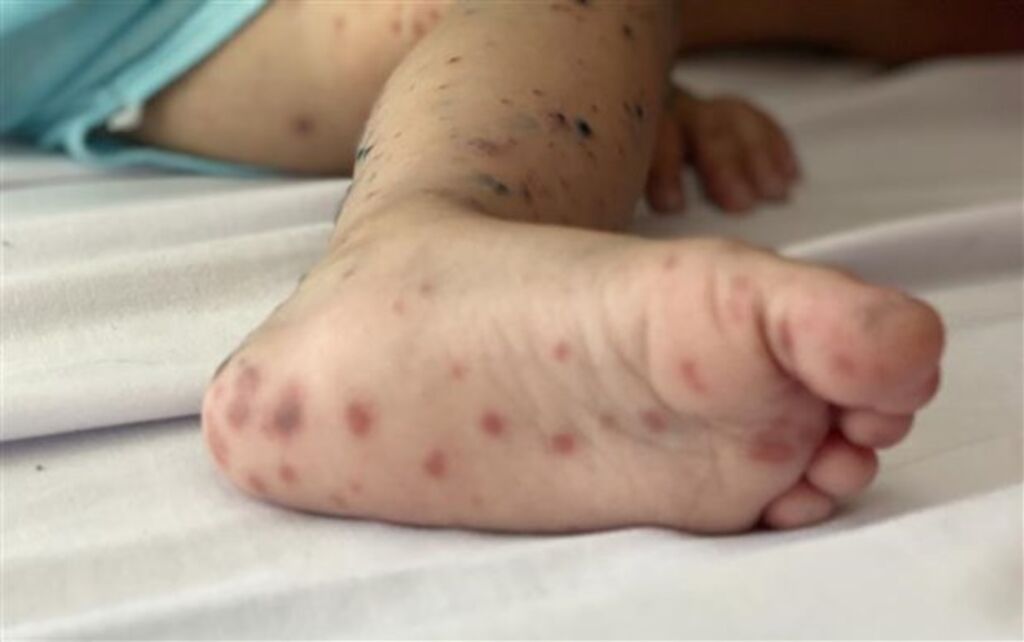 Đắk Lắk ghi nhận bệnh nhi 2 tuổi tử vong vì tay chân miệng